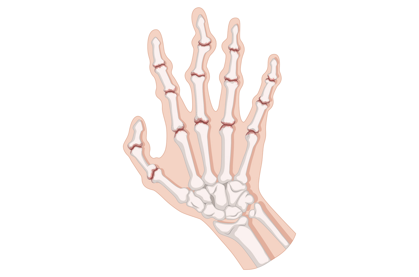 Le syndrome du canal carpien