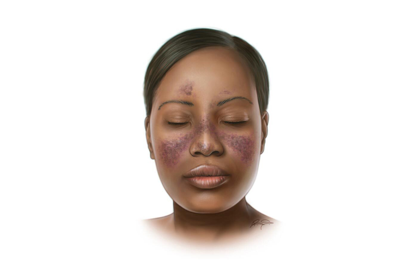 Lupus : une maladie auto-immune