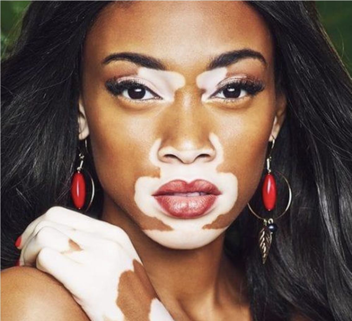 WINNIE HARLOW, LE MANNEQUIN QUI S’IMPOSE…AVEC SON VITILIGO